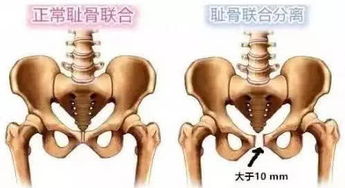 胎头高耻骨低能顺产吗图片