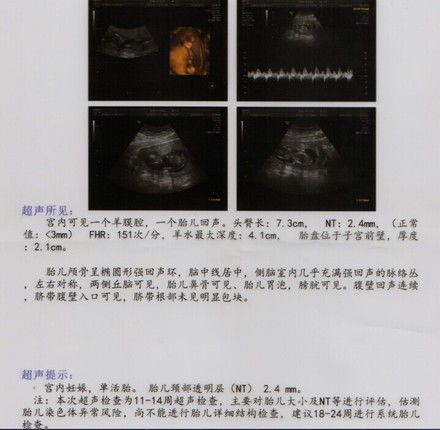 怀孕14周B超看胎儿性别准确吗?