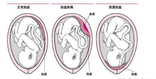 帆状胎盘可以多走动吗孕妇