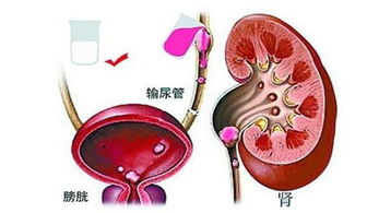 输尿管结石喝可乐有用吗?