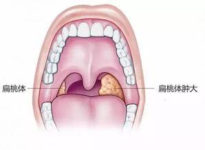 孕妇扁桃体发炎可以打针吗