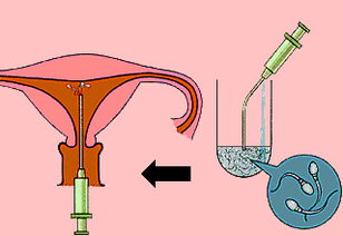 如何提高人工授精的成功率呢