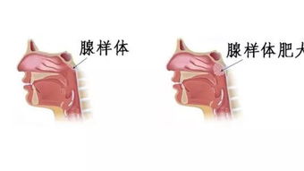 打鼾声音是嘴巴还是鼻子发出来的