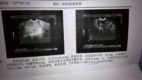 nt值高是什么原因导致的