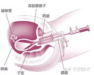 巧克力卵巢囊肿的偏方