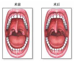 扁桃体炎可以吃石榴吗?