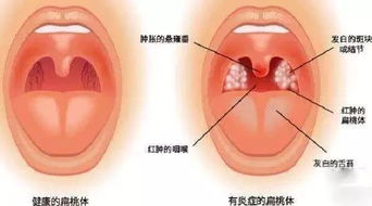 扁桃体炎可以吃石榴吗?