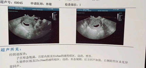 怀孕7周未见卵黄囊，胎儿正常吗？