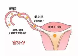 求助关于成都宫外孕社保报销问题