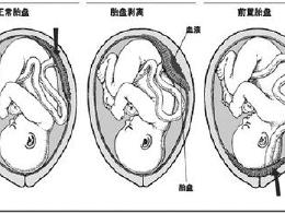 孕期出现前置胎盘怎么办呢