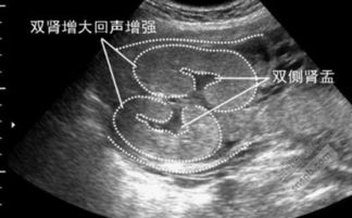 B超是怎样确认怀孕周数的?