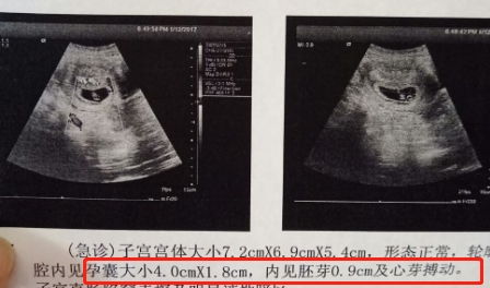 怀孕8周胎儿彩超图片