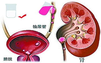 孕妇输尿管结石8mm能自己排出来吗视频