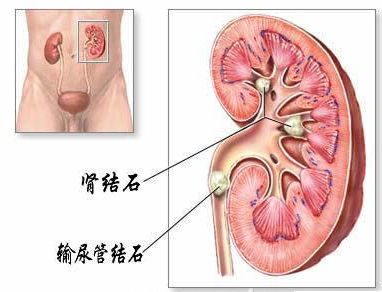 孕妇输尿管结石8mm能自己排出来吗视频