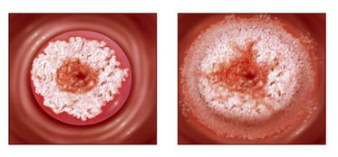 宫颈癌的早期症状表现