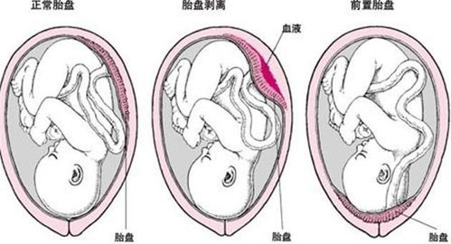 孕妇肠梗阻的治疗方法视频