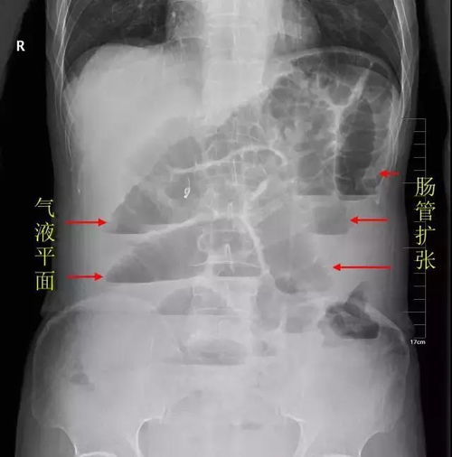 孕妇肠梗阻的治疗方法视频