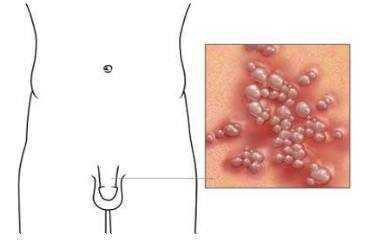 生殖疱疹不治疗会怎样会好吗