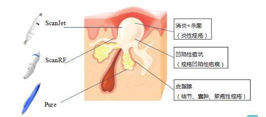 十五年的妊娠纹能消除吗？