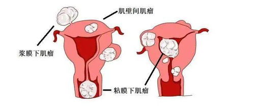 酸性体质的女人容易患妇科病吗