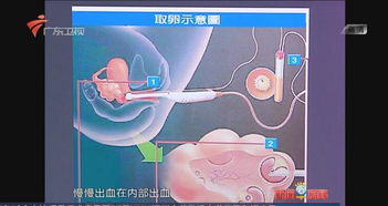 取卵手术是干嘛的