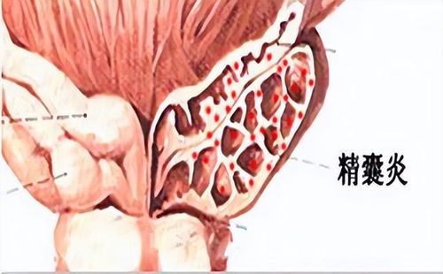 毛囊炎鸡蛋可以吃吗