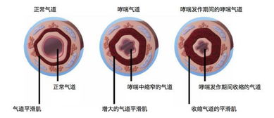 支气管炎会不会变成哮喘