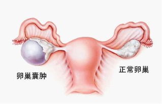 卵巢巧克力囊肿怎么治疗