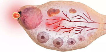 女性多囊卵巢是什么原因造成的