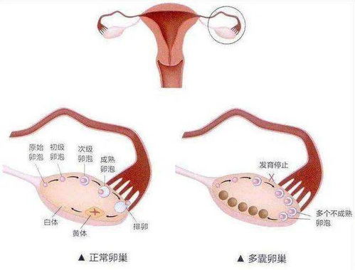 女性多囊卵巢是什么原因造成的