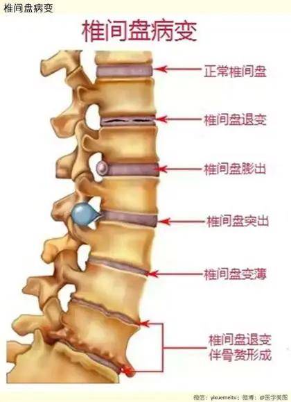 产后腰椎间盘突出怎么锻炼