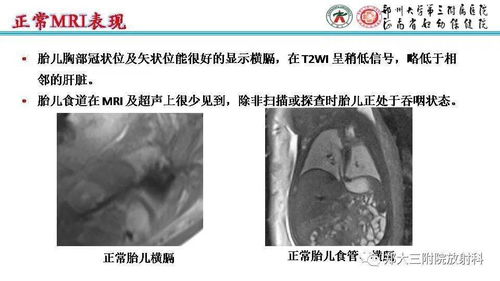 胎儿隔离肺能生吗