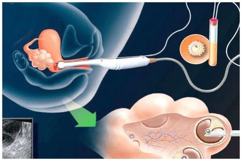 b超和取卵数不一样