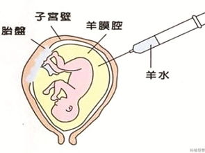 羊水穿刺怎么做的过程