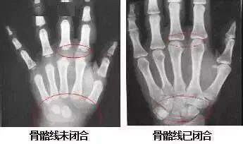 男孩11岁骨龄检测11岁还有多少长高空间