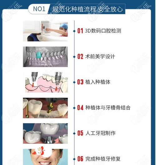 广州种植牙的价格大概是多少