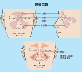 老是流鼻涕是不是鼻炎