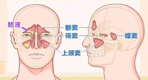 鼻炎怎样消除浓鼻涕