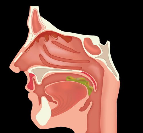 鼻炎怎样消除浓鼻涕