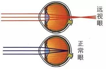 近视是怎么遗传的