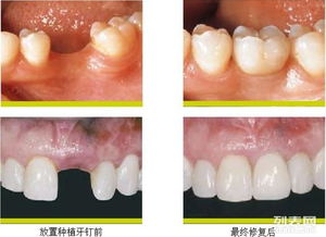 上海假牙的种类及价格