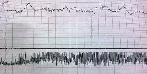 什么是胎心率？