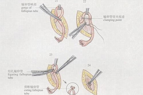 结扎后如果想生二胎会有什么影响