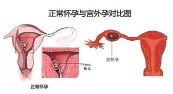 宫外孕术后复查什么？