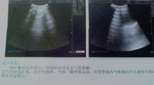 教你看懂b超单图解