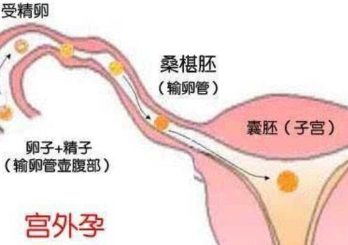 孕妇小腹胀痛怎么办缓解