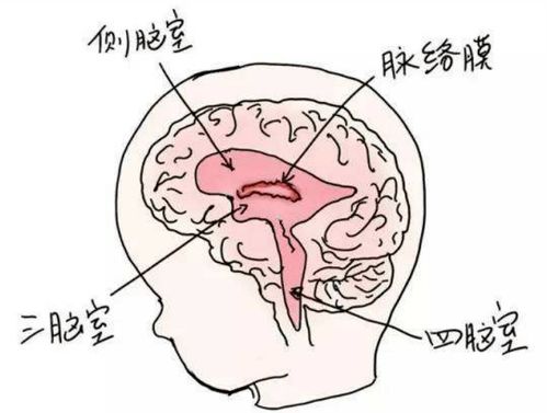 胎儿脉络丛囊肿严重吗