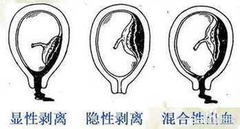 胎盘早老化是什么原因造成的怎么办