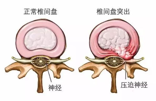 三伏贴可以治疗腰椎盘突出吗