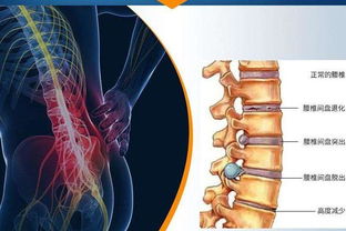 三伏贴可以治疗腰椎盘突出吗